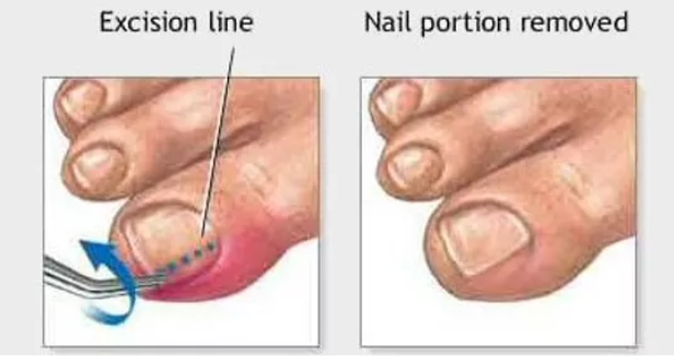 Ingrown Toenail Procedure